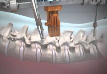 Top best robotic spine surgery hospitals in India