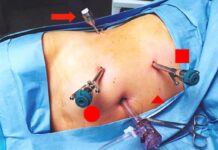 Robot-assisted laparoscopic pyeloplasty – Benefits and risks robot-assisted laparoscopic pyeloplasty