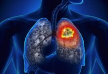 Artificial intelligence (AI) in Lung Cancer Screening Lung Cancer